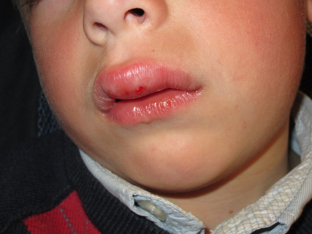 botox like injections